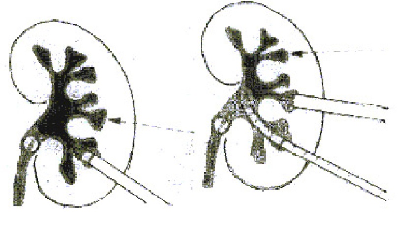 Percutaneous Nephrolithotomy Keyhole Surgery For Kidney Stones