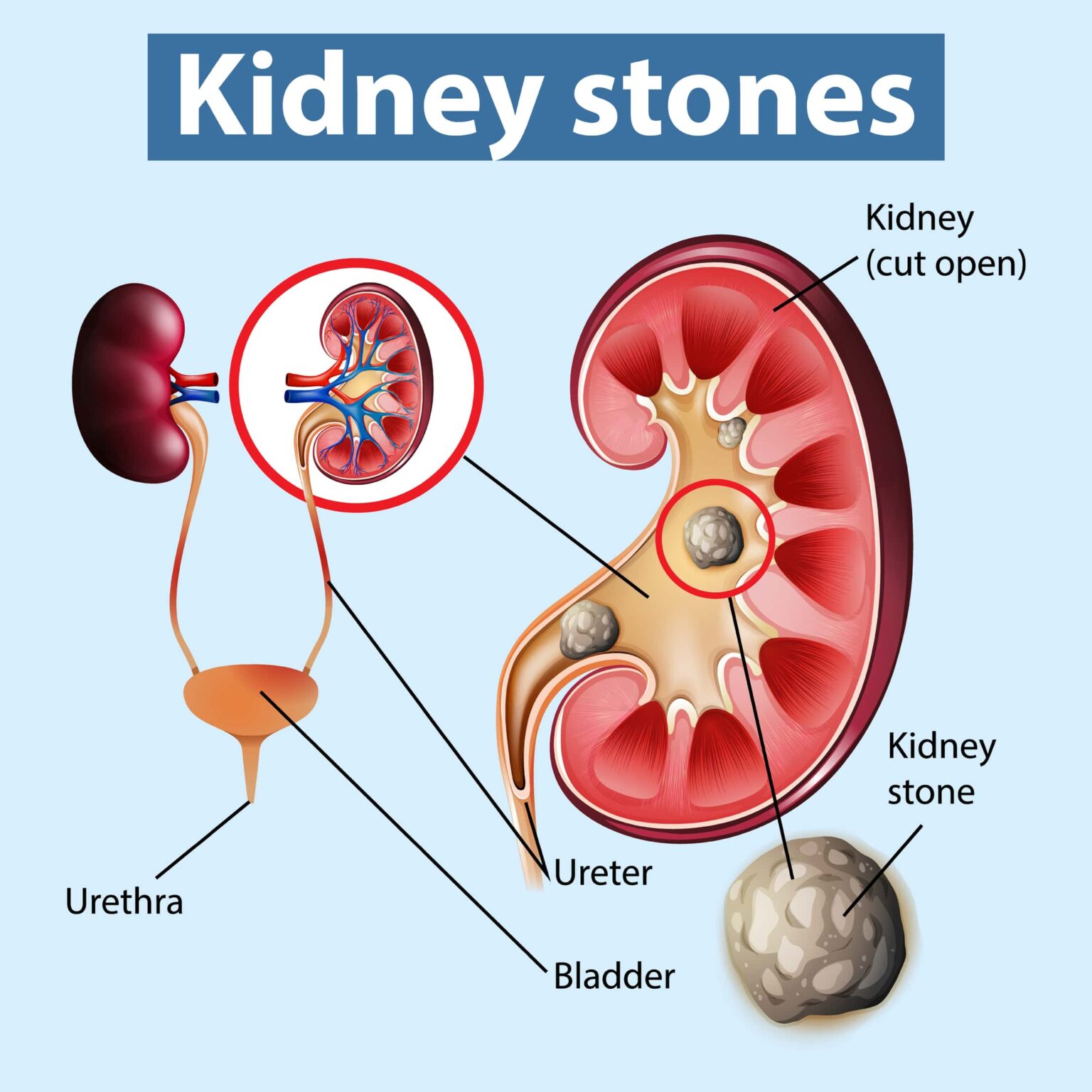 kidney-stones-dr-brojen-barman